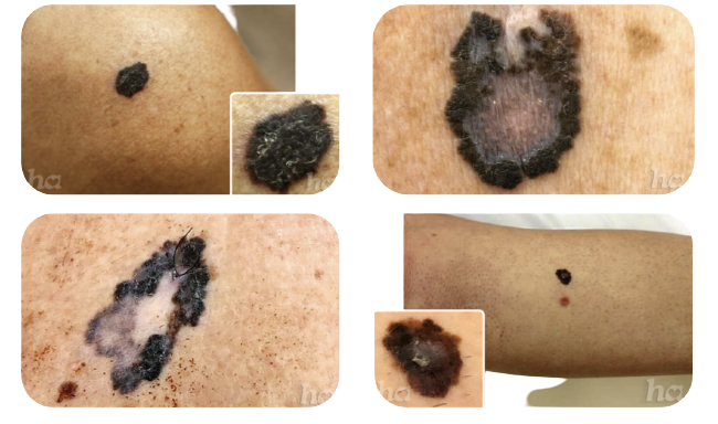 Melanoma